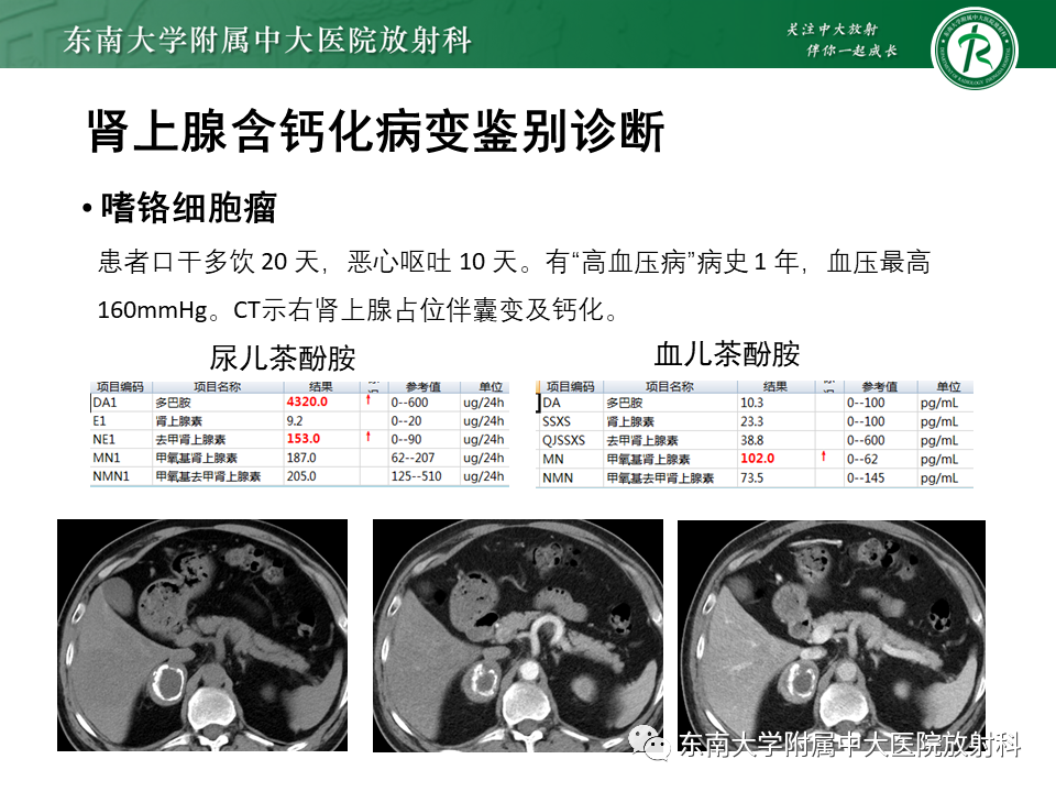 影像PPT - 【PPT】肾上腺占位病例随访-12