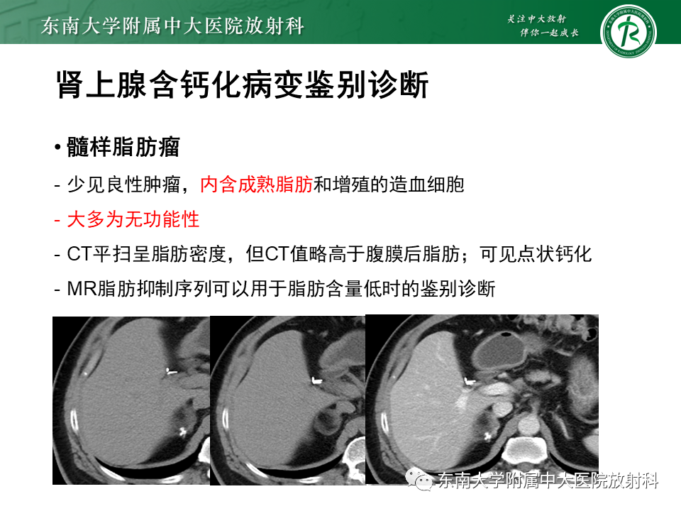 影像PPT - 【PPT】肾上腺占位病例随访-14