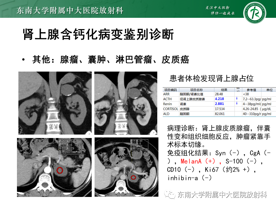 影像PPT - 【PPT】肾上腺占位病例随访-16