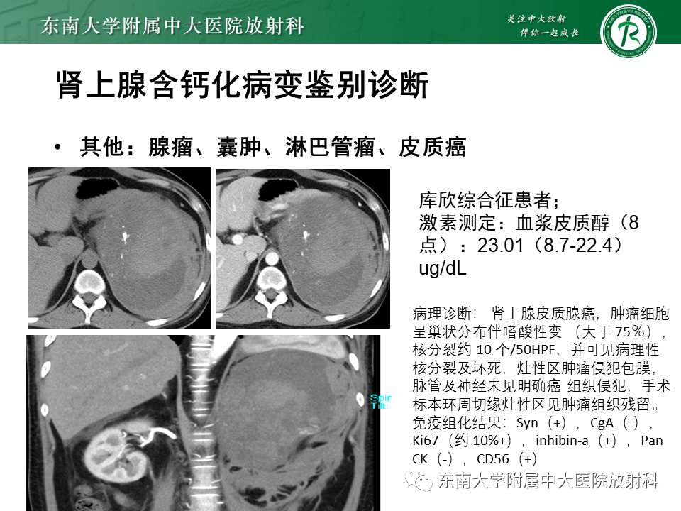 影像PPT - 【PPT】肾上腺占位病例随访-17