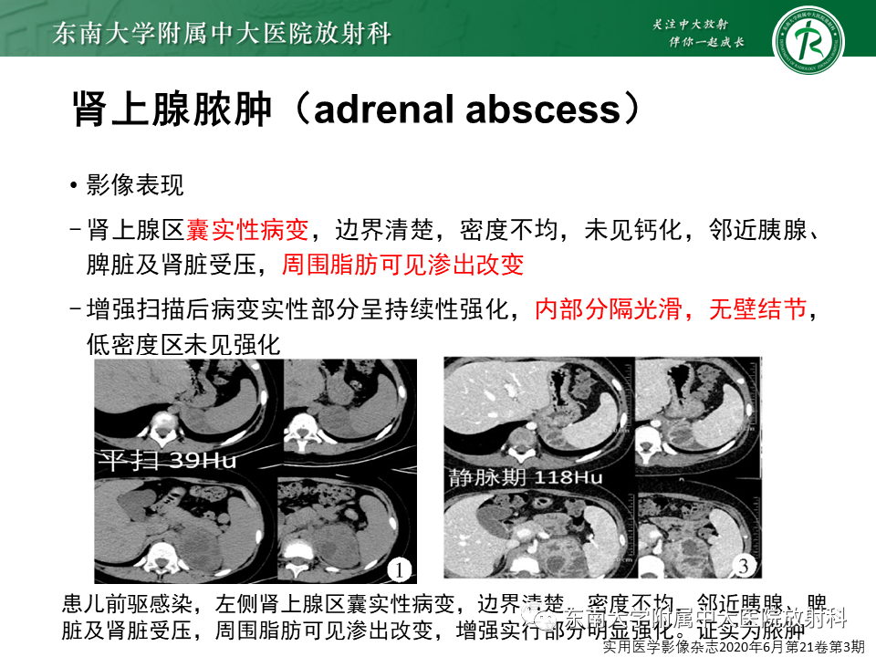 影像PPT - 【PPT】肾上腺占位病例随访-19