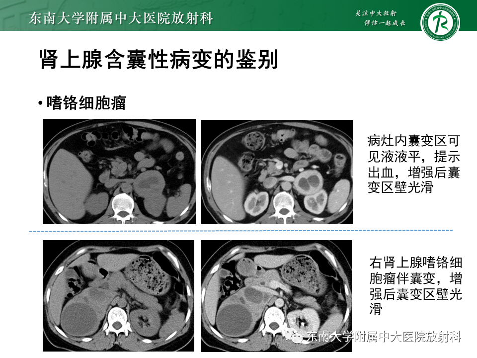 影像PPT - 【PPT】肾上腺占位病例随访-25