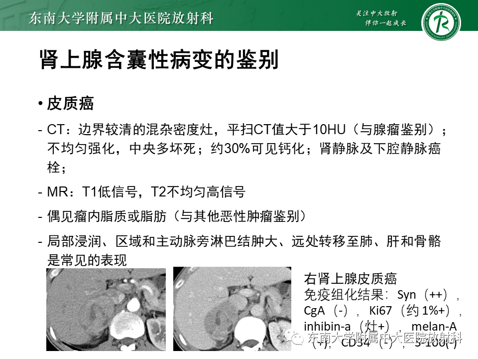 影像PPT - 【PPT】肾上腺占位病例随访-27