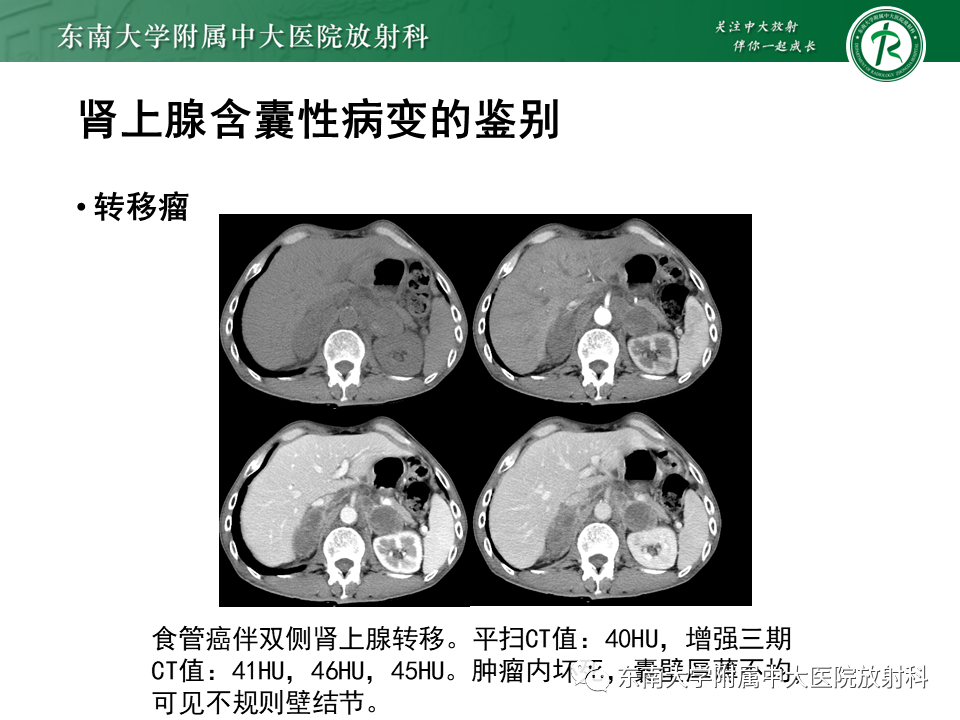 影像PPT - 【PPT】肾上腺占位病例随访-28
