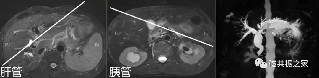 影像PPT - 上腹部+MRCP该如何扫描-19 影像PPT - 上腹部+MRCP该如何扫描-19