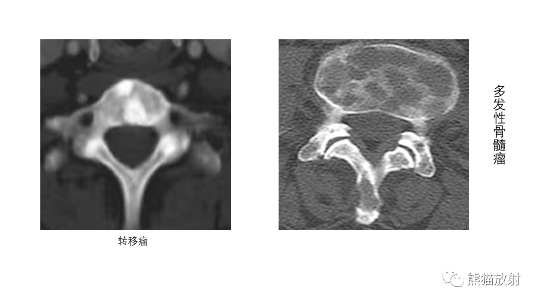 影像PPT - 【病例】多发性骨髓瘤2例CT及MR影像-33