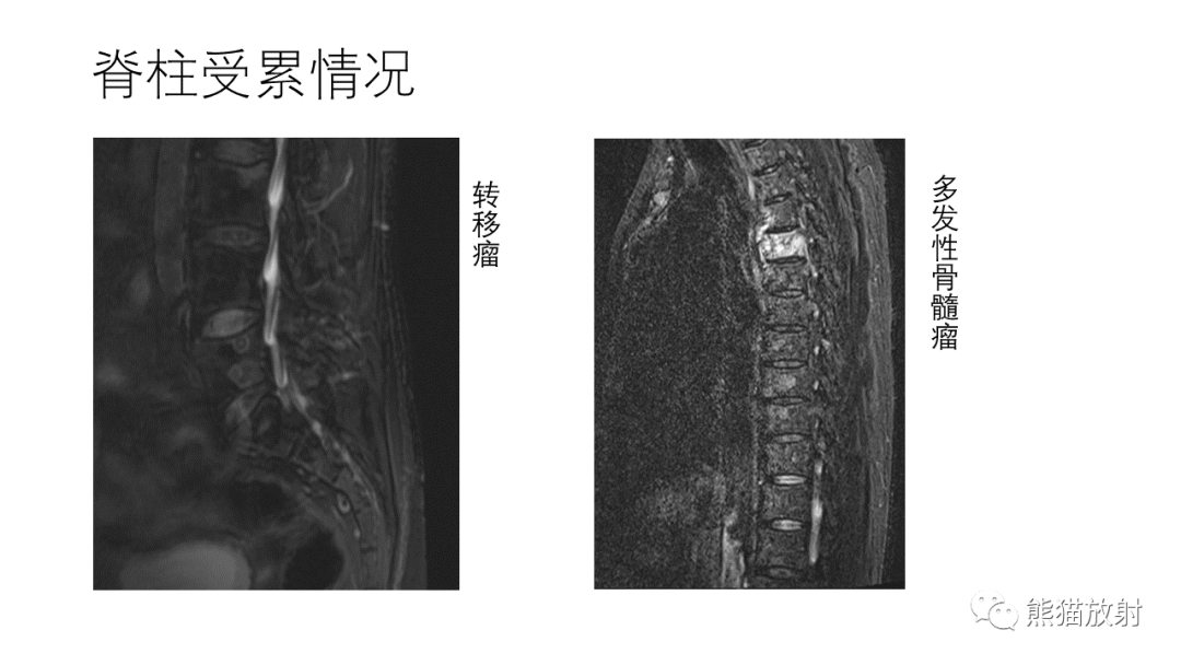 影像PPT - 【病例】多发性骨髓瘤2例CT及MR影像-34