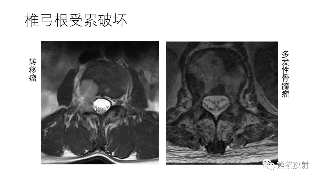 影像PPT - 【病例】多发性骨髓瘤2例CT及MR影像-35