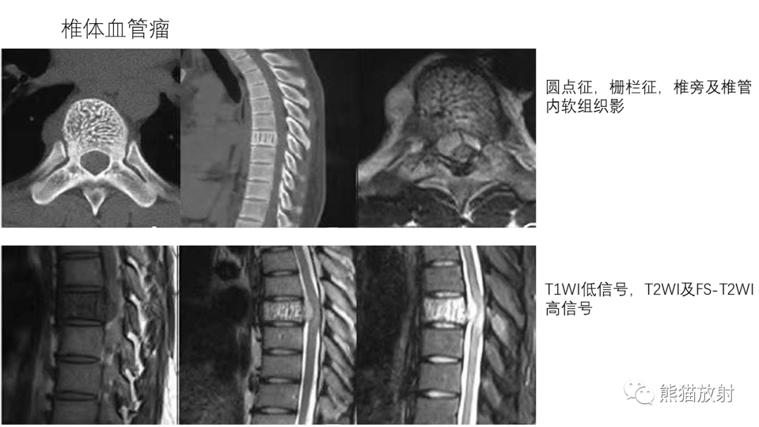 影像PPT - 【病例】多发性骨髓瘤2例CT及MR影像-41