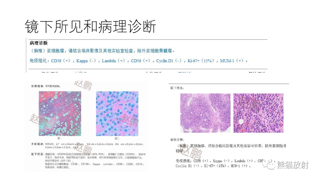 影像PPT - 【病例】多发性骨髓瘤2例CT及MR影像-7