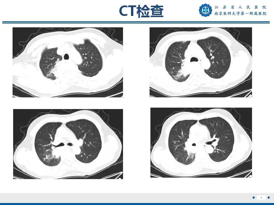 影像PPT - 【PPT】肺脓肿-4