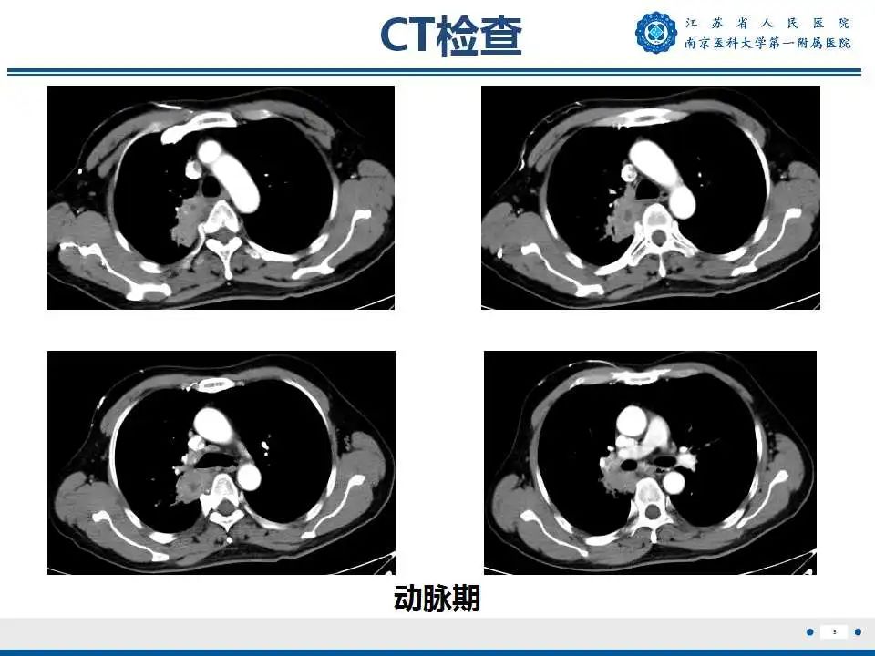 影像PPT - 【PPT】肺脓肿-5