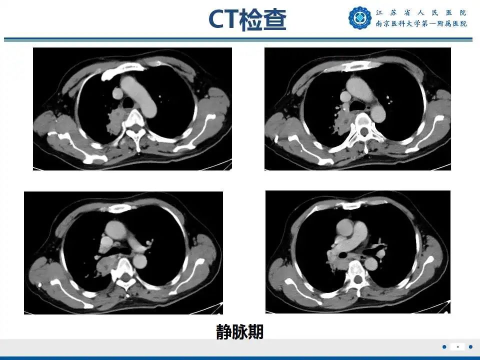 影像PPT - 【PPT】肺脓肿-6