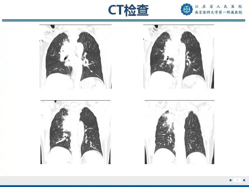 影像PPT - 【PPT】肺脓肿-7