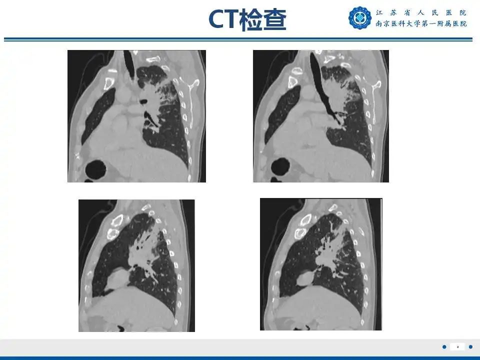 影像PPT - 【PPT】肺脓肿-8