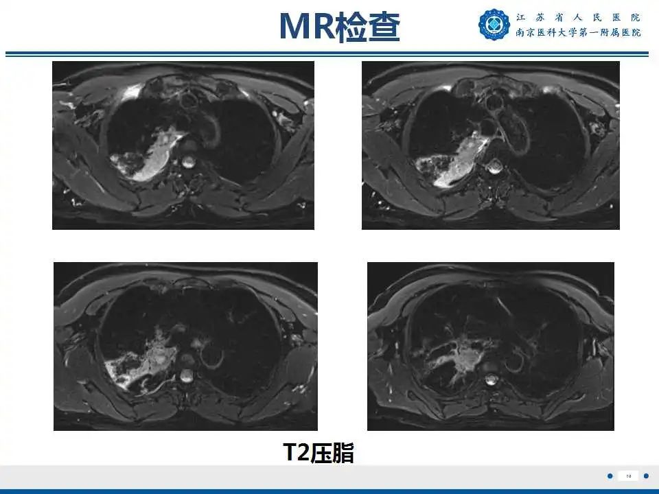 影像PPT - 【PPT】肺脓肿-10