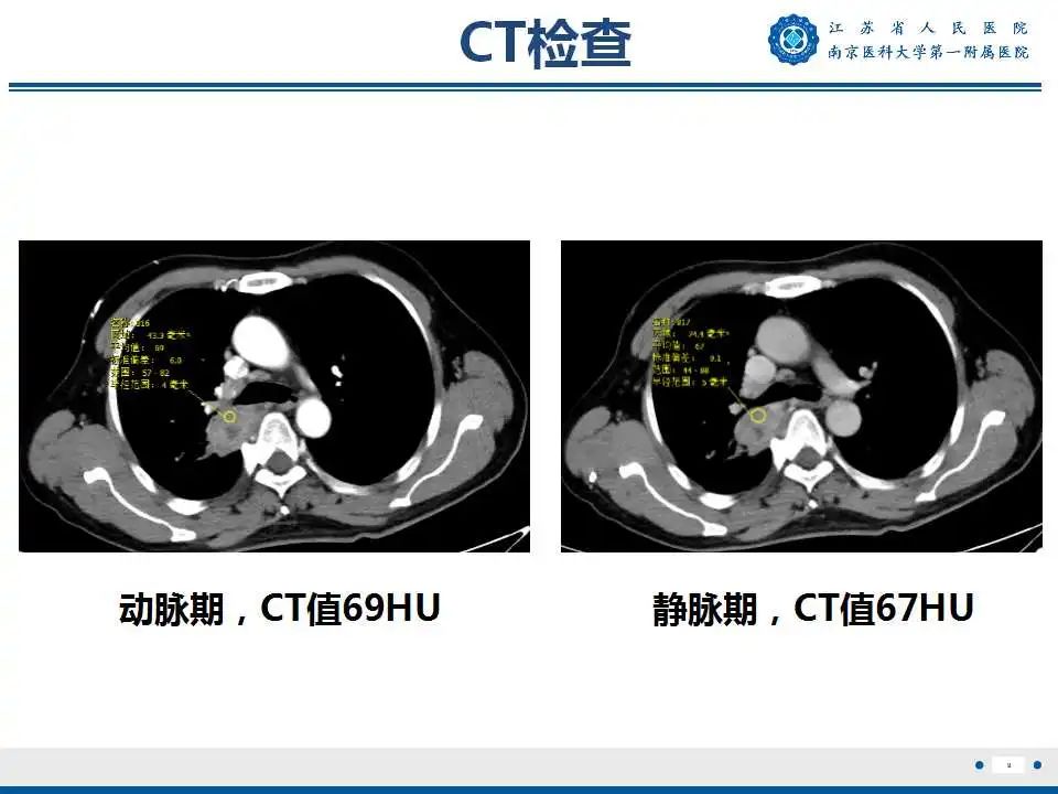 影像PPT - 【PPT】肺脓肿-9