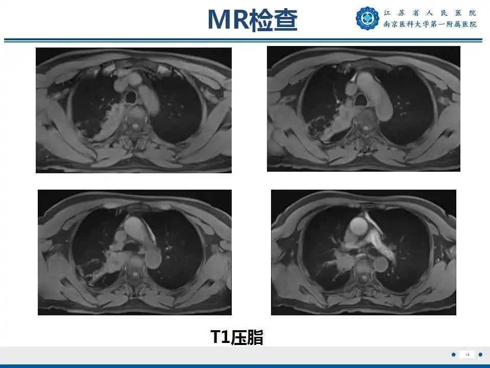 影像PPT - 【PPT】肺脓肿-12