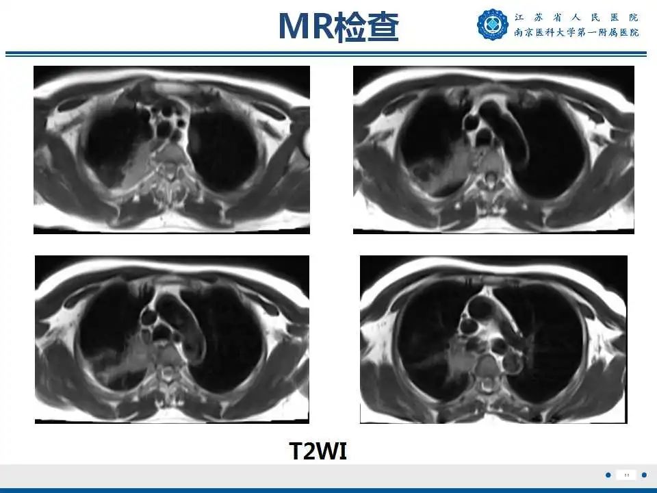 影像PPT - 【PPT】肺脓肿-11