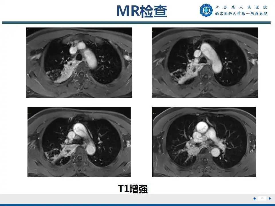 影像PPT - 【PPT】肺脓肿-13