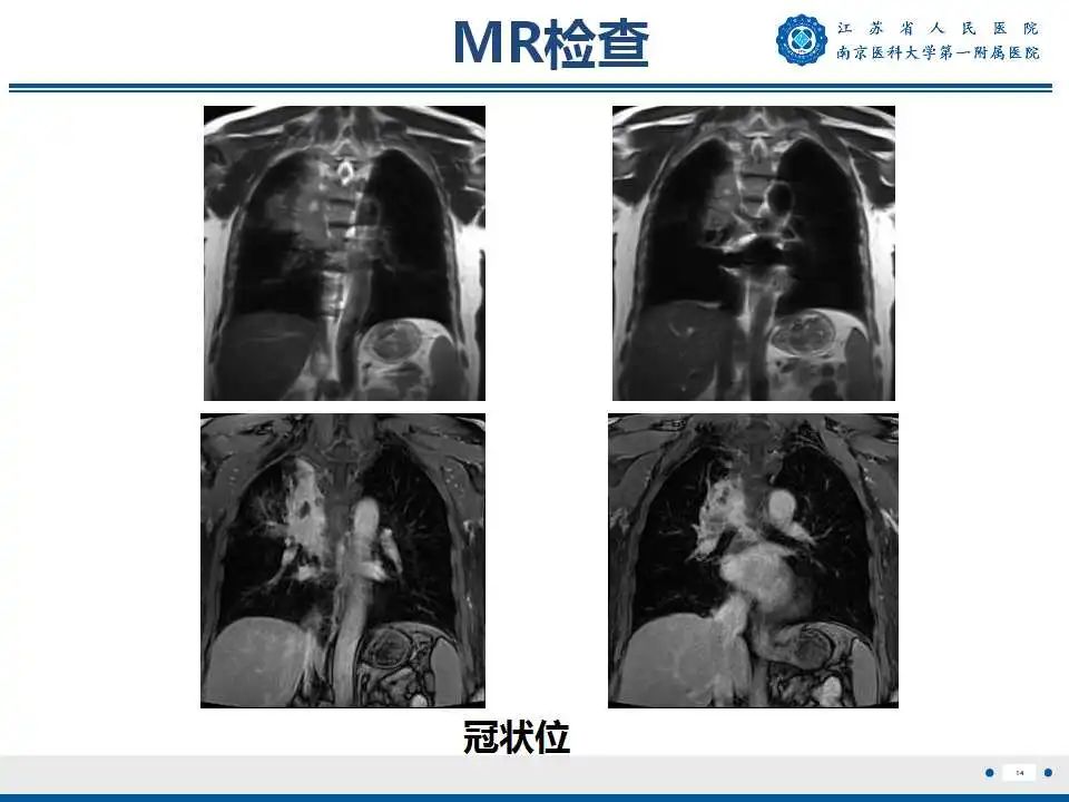 影像PPT - 【PPT】肺脓肿-14