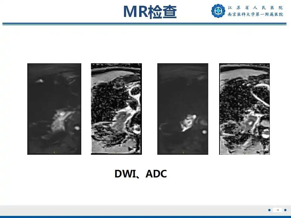 影像PPT - 【PPT】肺脓肿-15