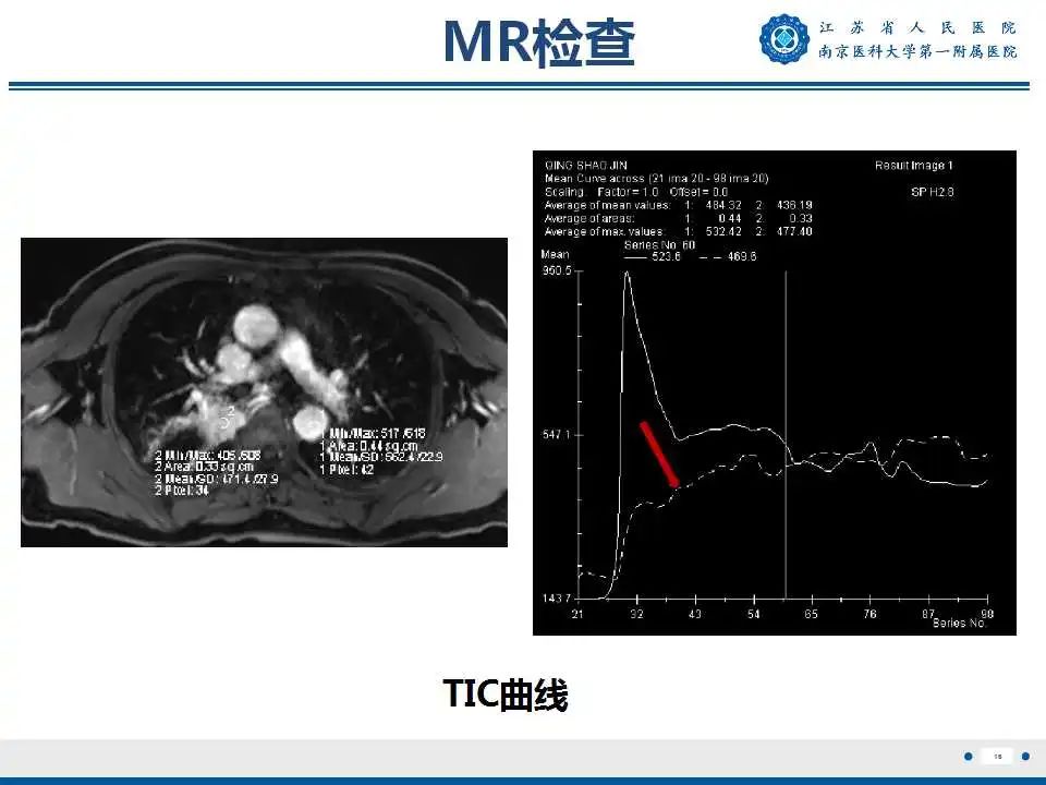 影像PPT - 【PPT】肺脓肿-16