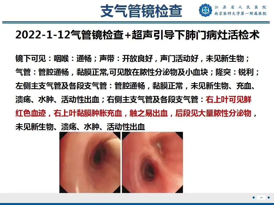 影像PPT - 【PPT】肺脓肿-24