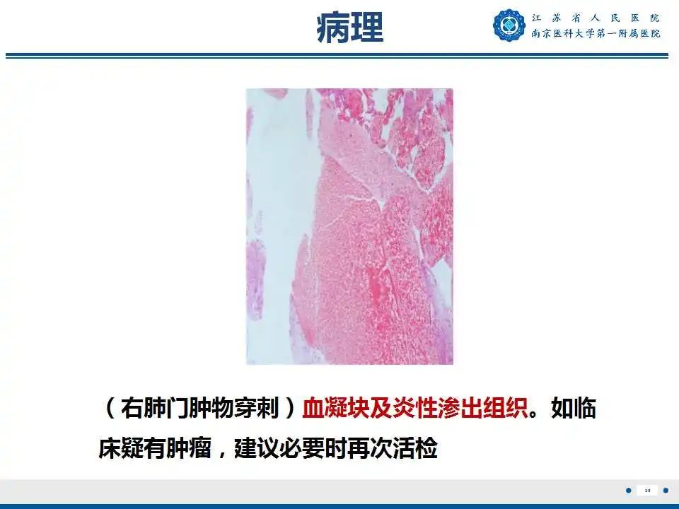 影像PPT - 【PPT】肺脓肿-25