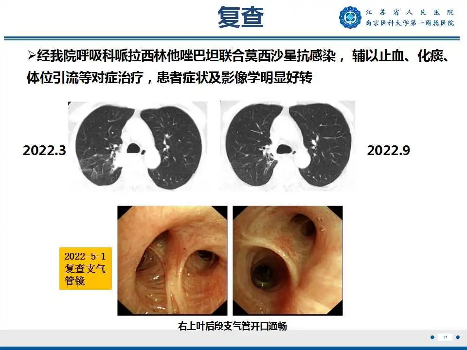 影像PPT - 【PPT】肺脓肿-27