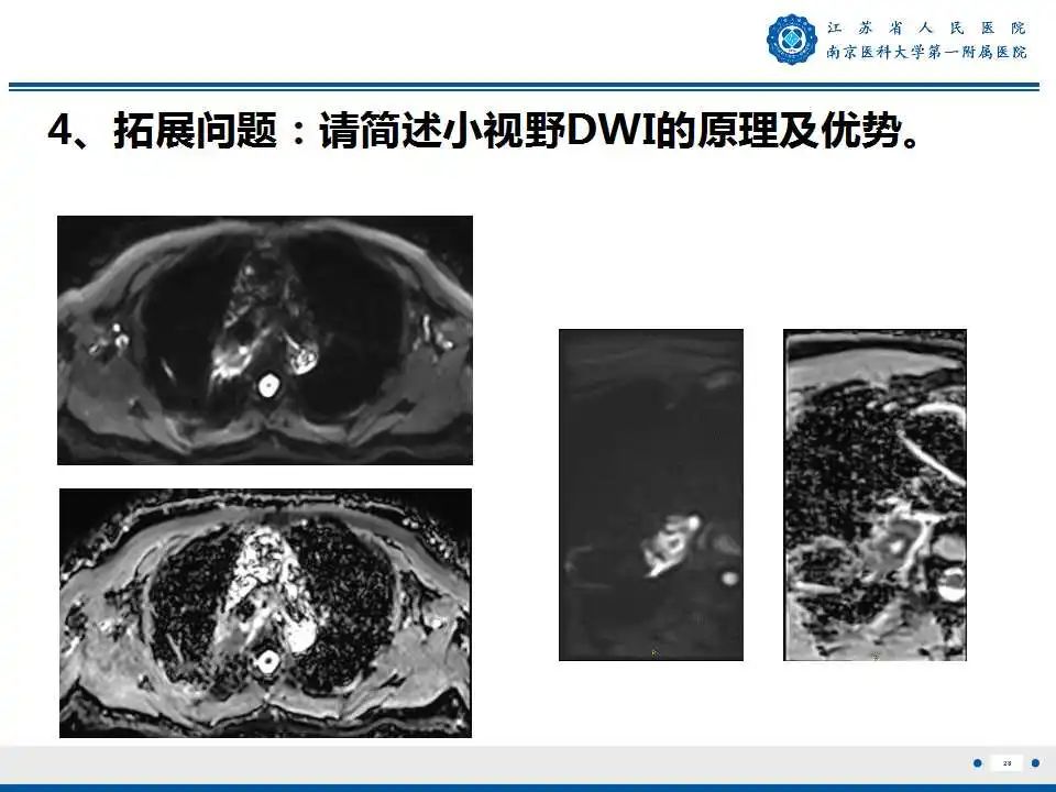 影像PPT - 【PPT】肺脓肿-28