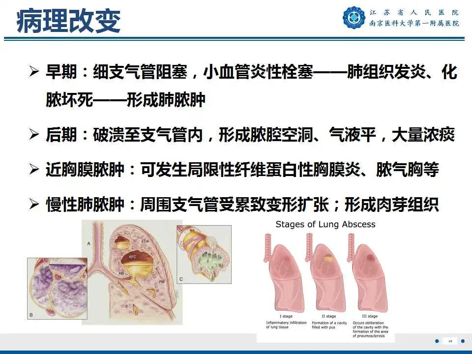 影像PPT - 【PPT】肺脓肿-38