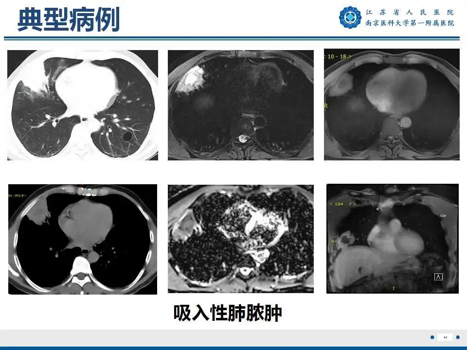 影像PPT - 【PPT】肺脓肿-42