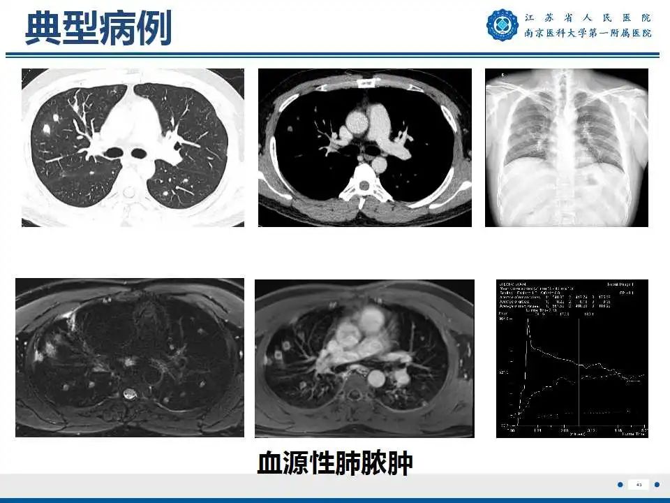 影像PPT - 【PPT】肺脓肿-43