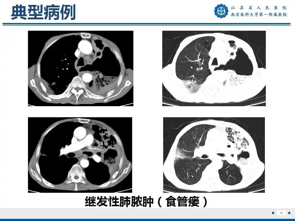 影像PPT - 【PPT】肺脓肿-44