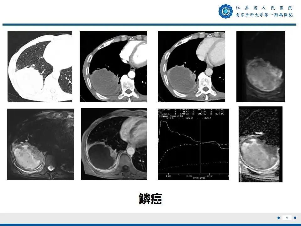 影像PPT - 【PPT】肺脓肿-49