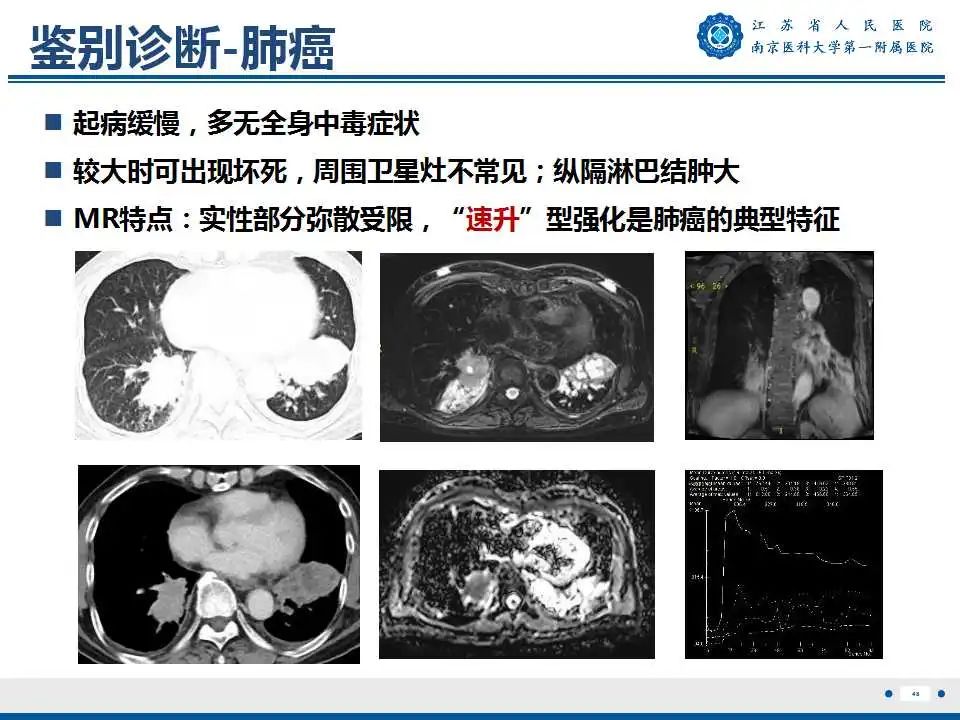 影像PPT - 【PPT】肺脓肿-48