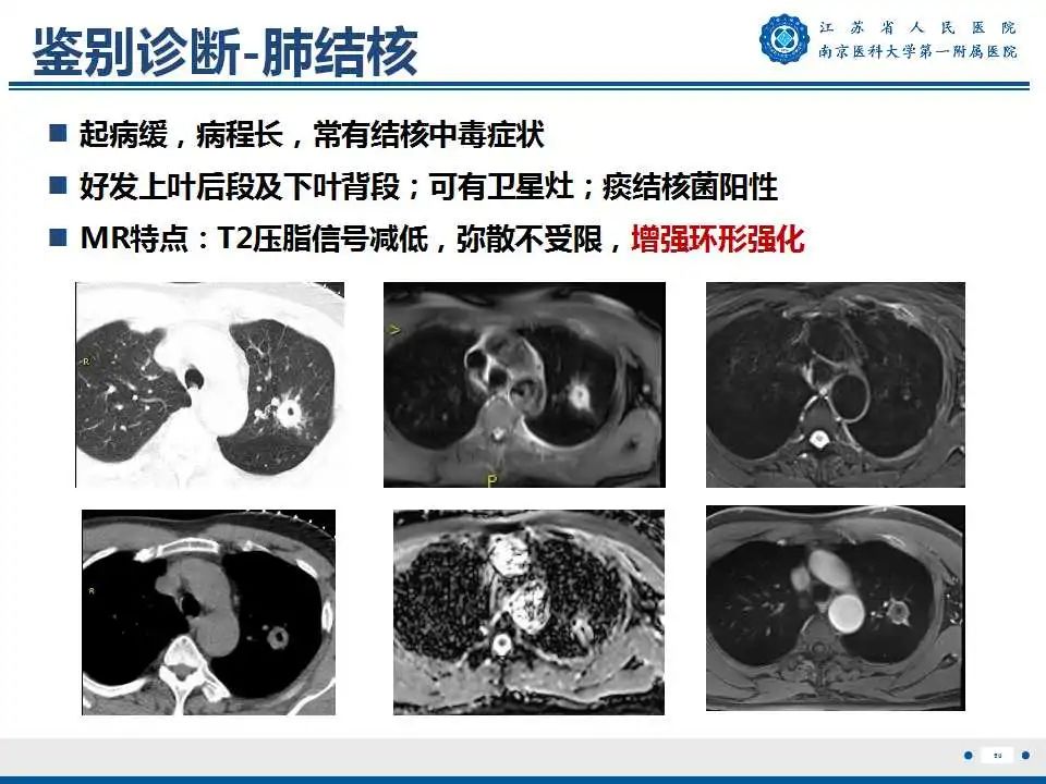 影像PPT - 【PPT】肺脓肿-50