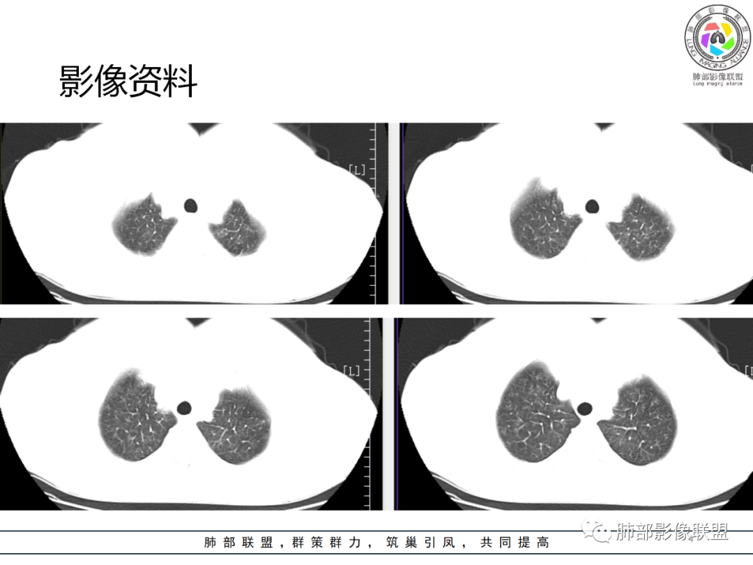 影像PPT - 【病例】肺泡蛋白沉积症1例CT影像-4 影像PPT - 【病例】肺泡蛋白沉积症1例CT影像-4