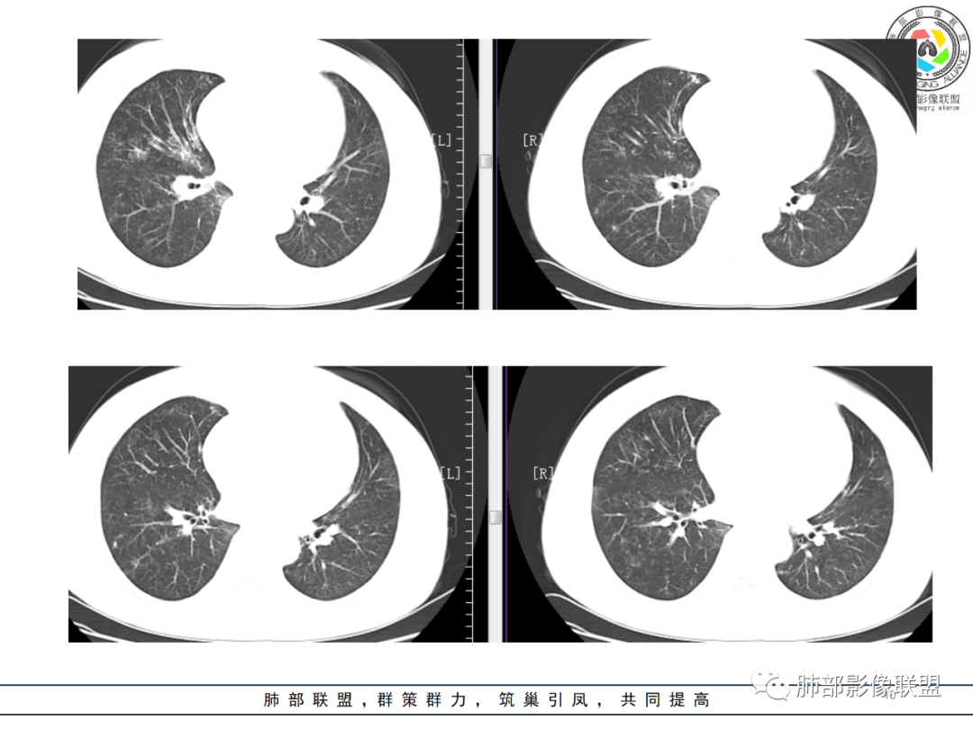 影像PPT - 【病例】肺泡蛋白沉积症1例CT影像-10 影像PPT - 【病例】肺泡蛋白沉积症1例CT影像-10