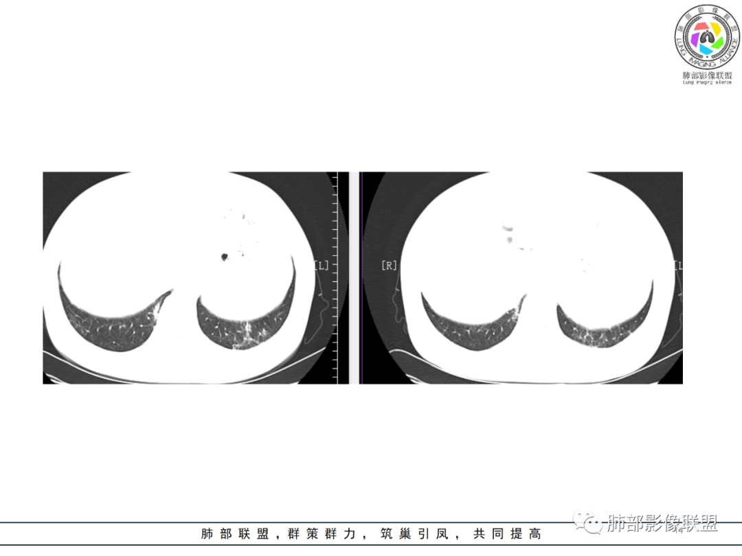影像PPT - 【病例】肺泡蛋白沉积症1例CT影像-14 影像PPT - 【病例】肺泡蛋白沉积症1例CT影像-14