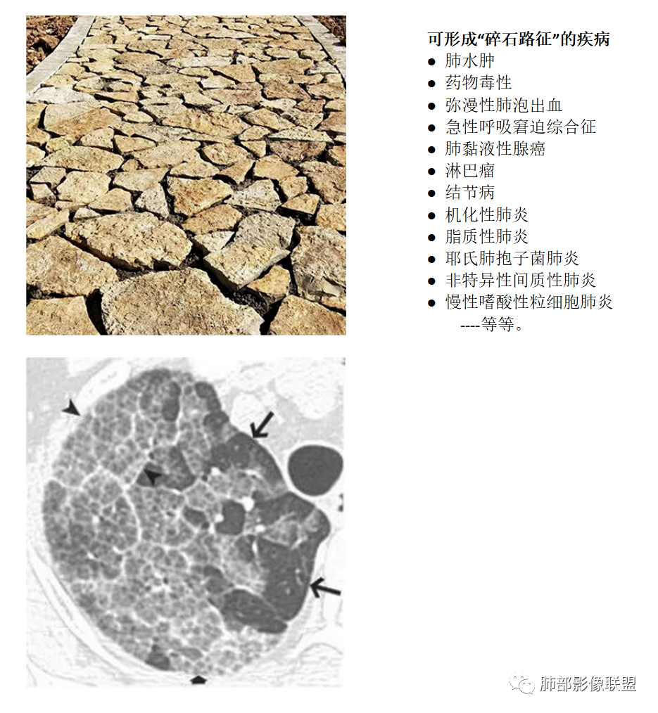 影像PPT - 【病例】肺泡蛋白沉积症1例CT影像-25 影像PPT - 【病例】肺泡蛋白沉积症1例CT影像-25