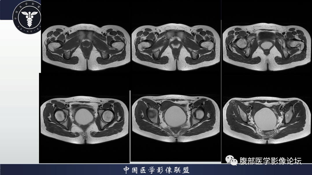 影像PPT - 【病例】先天性阴道闭锁1例MR影像-3