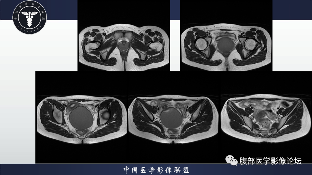 影像PPT - 【病例】先天性阴道闭锁1例MR影像-6