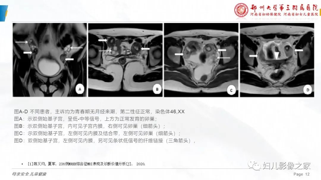 影像PPT - 【病例】先天性阴道闭锁1例MR影像-23