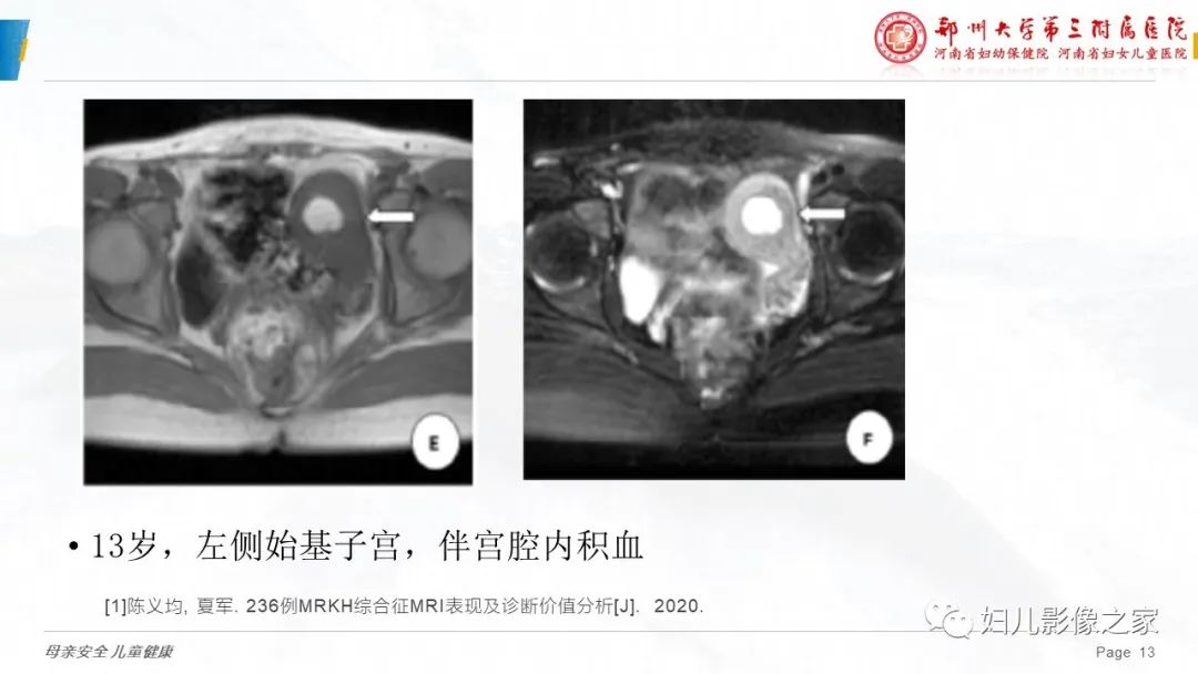 影像PPT - 【病例】先天性阴道闭锁1例MR影像-24