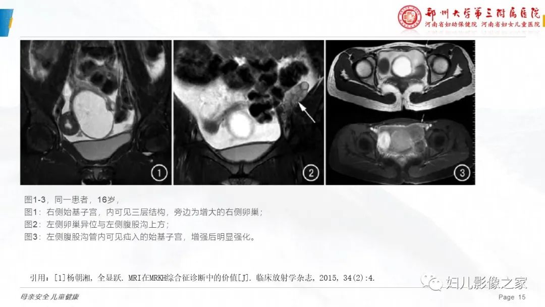 影像PPT - 【病例】先天性阴道闭锁1例MR影像-26