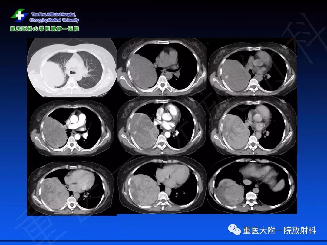 影像PPT - 【PPT】孤立性纤维瘤的影像学诊断及鉴别诊断-14