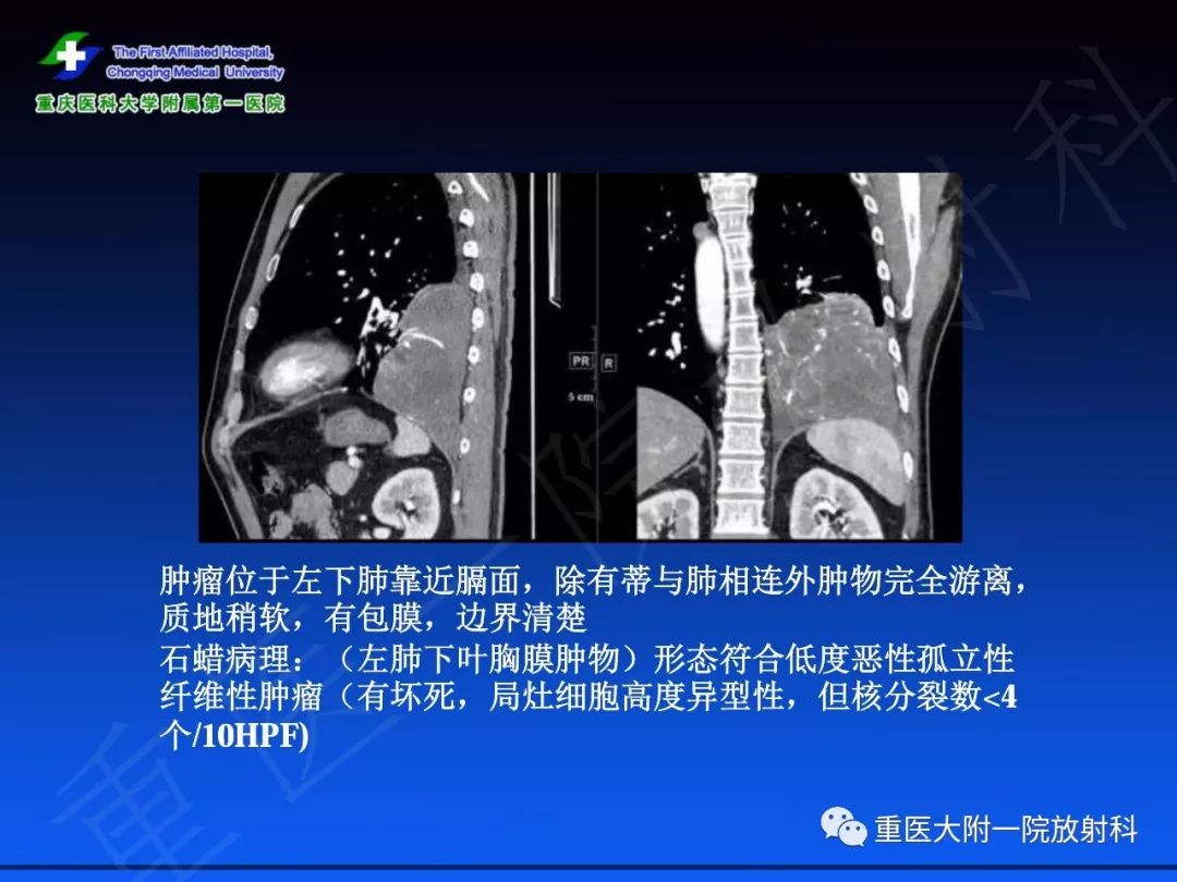 影像PPT - 【PPT】孤立性纤维瘤的影像学诊断及鉴别诊断-17
