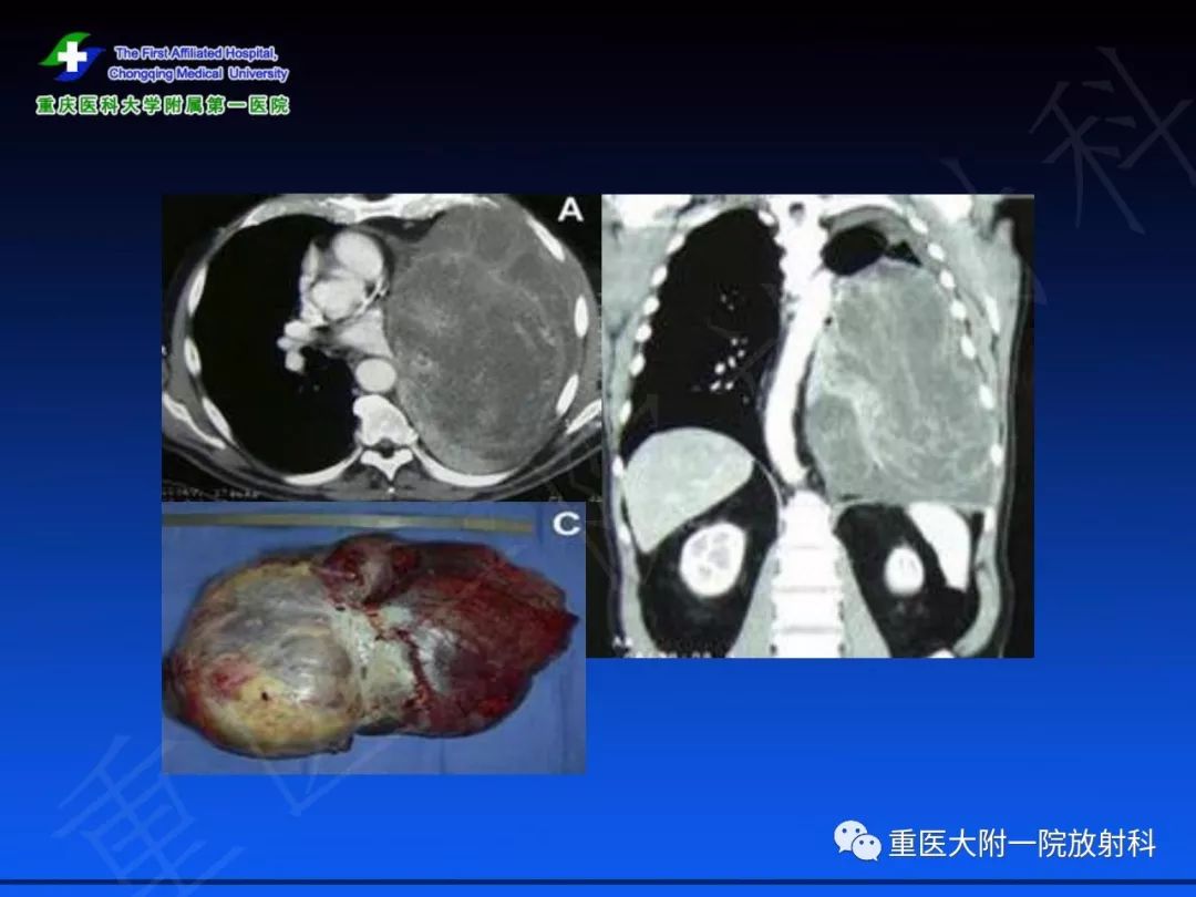 影像PPT - 【PPT】孤立性纤维瘤的影像学诊断及鉴别诊断-18